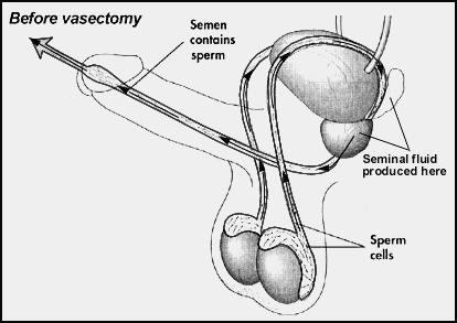 before vasectomy animation