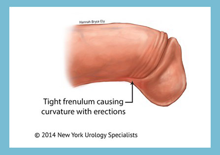 Penile frenulectomy for curve Red Deer